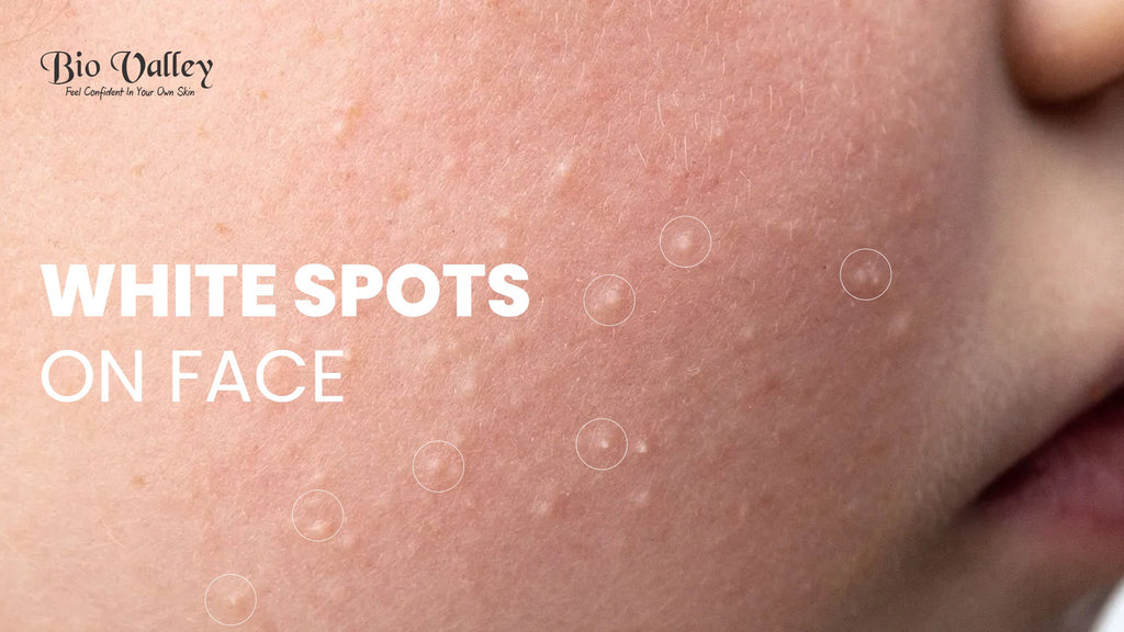 White Spots On Face And Skin: Causes, Reasons, And Treatment