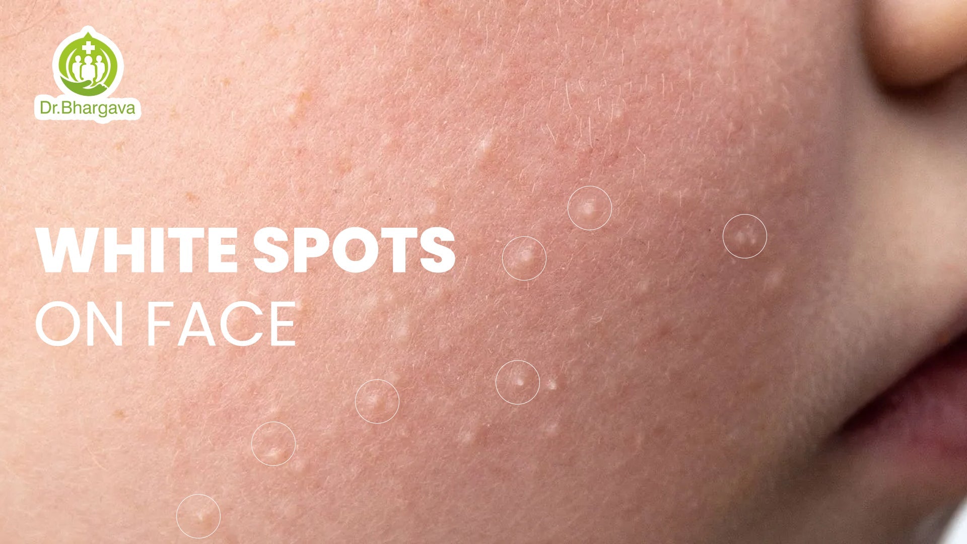 White Spots On Face