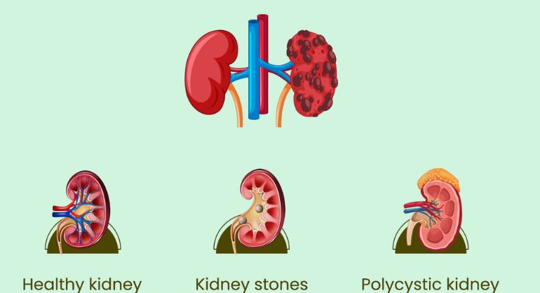 Best Kidney Stone Solution in homeopathy 