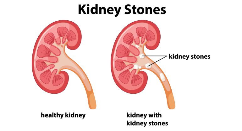 Kidney stones Homeopathic Medicine  - Kidflame Tablet