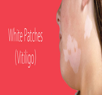 White Patches Homeopathic Medicine - Doctor Bhargava