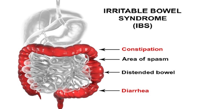 Small Intestines Infection Medicine